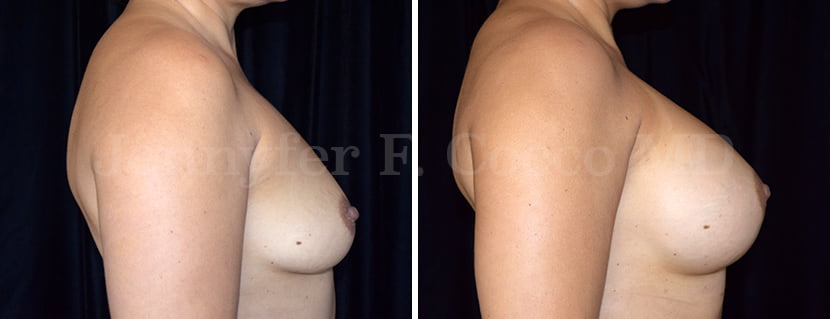 Mammoplasty with Implants in Dallas, TX - Case F - Right Side