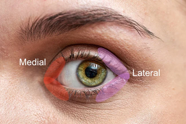 Medial and Lateral Canthopexy / Canthoplasty treatment areas