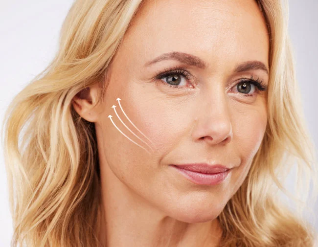 Midface Lift in Dallas, TX - Cheek Lift
