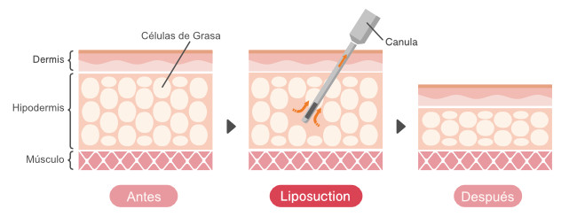El Proceso de la Liposucción