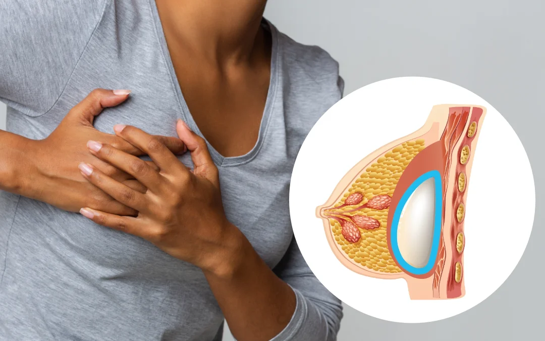 ¿Qué es la Contractura Capsular de los Implantes Mamarios?