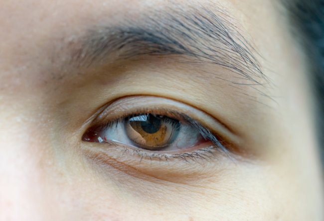 Reparación de Ptosis en Dallas, TX