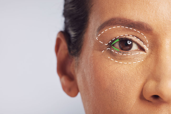 Revision Blepharoplasty in Dallas, TX - Secondary Eyelid Surgery