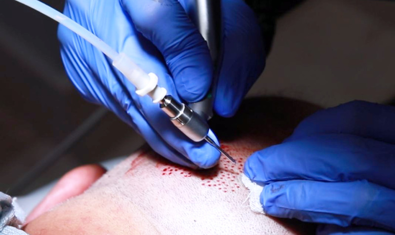 SmartGraft FUE Punch Tool