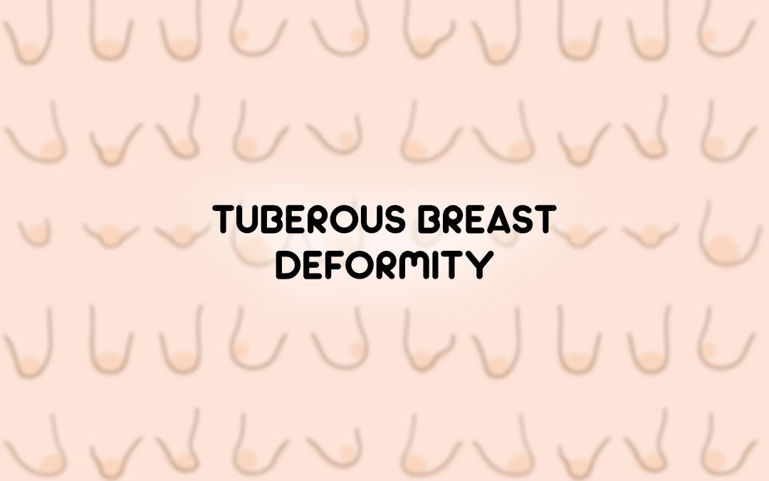 Tuberous Breast Deformity - Tubular Breasts - Featured Image