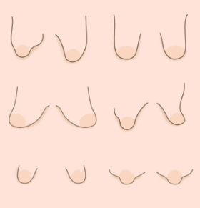 Tuberous Breast Deformity Types, Grades and Classifications
