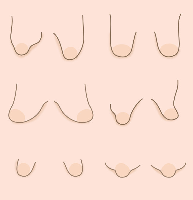Tuberous Breast Deformity Types and Grades