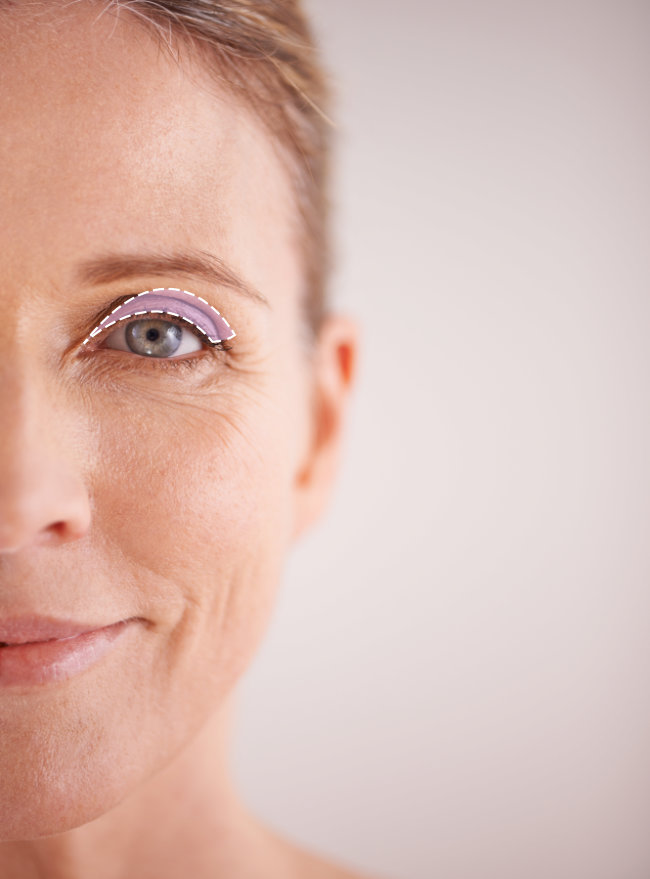 Upper Blepharoplasty in Dallas, TX